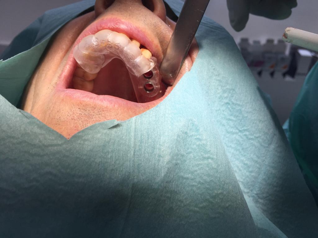 Cirugía de implantes Férula quirúrgica